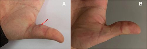 Figure 1 (A) Physical examination reveals an indurated erythematous plaque on the middle of the right thumb, and a few clear liquids can be observed when pressed. (B) The skin lesion is healed after an anti-tuberculous therapy.