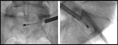 Figure 14 AP view (left) and lateral view (right) images showing final placement of bipolar radiofrequency (RF) probe in S1 vertebrae.