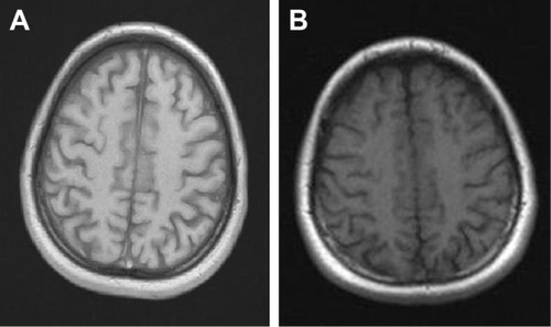 Figure 1 (A) Before the HBOT and (B) after the HBOT.