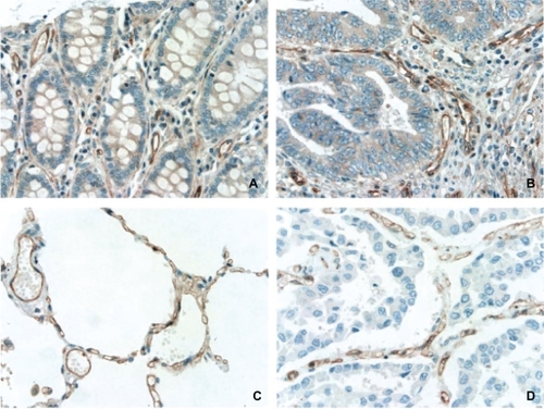 Figure 4 Expression of Notch-1 protein in endothelial cells of vasculature from noncancer colorectum (A), noncancer lung (C), colorectal adenocarcinoma (B), and lung squamous cell carcinoma (D). Original magnification, 400X.