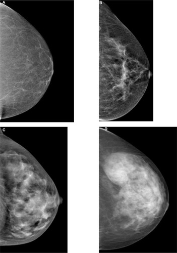 Figure 1 The four breast parenchymal patterns.