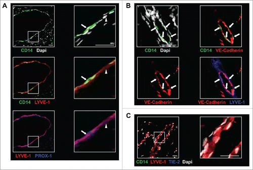 Figure 5. In BC tumors, TEM are associated with lymphatic structures. (A) TEM (arrow, CD14+LYVE-1+PROX-1+ cells) were associated with lymphatic vessels (arrowhead, CD14-LYVE-1+PROX-1+ cells); (B) Immunofluorescence labeling of TEM-containing lymphatics (arrows) with VE-cadherin; (C) Immunofluorescence labeling in sections of non-neoplastic breast tissue adjacent to tumor tissues shows no TEM association with LYVE-1+ lymphatic vessels. Scale bars: 25 μm. Representative image from seven patients.