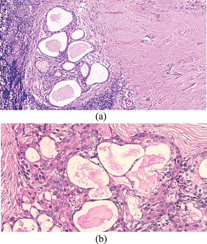 Figure 3. (a) Histological micrograph for SMEC with low neoplastic cellularity showing hyalinosclerosis, peripheral tumor-associated lymphoid proliferation and moderate mucin production (H&E, ×10); (b) high power imaging of the diagnostic areas showing mucoepidermoid carcinoma islands (H&E, ×40).
