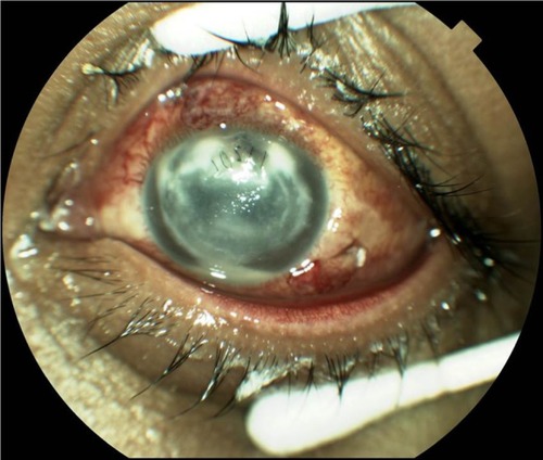 Figure 5 Posttraumatic endophthalmitis (note the sutured corneal wound and hypopyon).