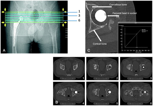 Figure 2. A. Scanogram. B. Sequential CT slices surrounding the acetabular component. C. measurement of cancellous BMD. In total, 6 axial scans were performed starting 10 mm above the socket, parallel to the horizontal teardrop line.