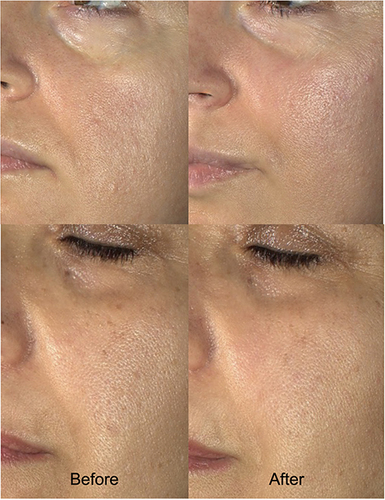 Figure 6 Photographs of selected participants before and after 4 weeks of treatment with a KP1 face cream. Courtesy of DERMING, S.r.l.