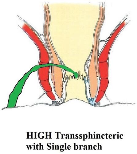 Figure 1 A high transsphincteric fistula.