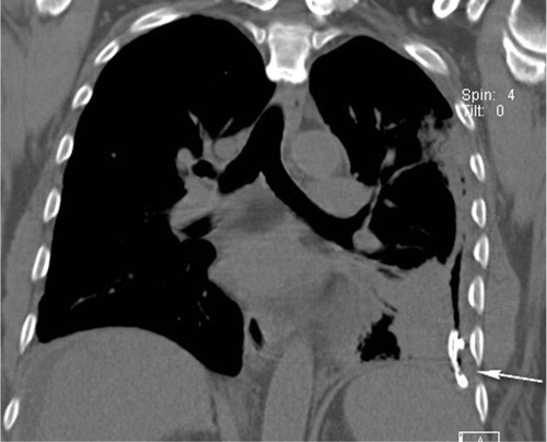 Fig. 4 Coronal image of the chest demonstrates a small bore chest tube partially surrounded by air in the left pleural space (arrow). No remaining fluid is seen. Adjacent lung consolidation has decreased.