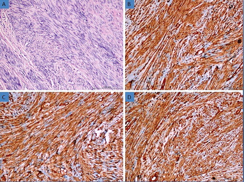 Figure 4. (a) Histomorphological appearance of the usual leiomyoma (H&E, 200×). (b) Strong expression of AQP3 in leiomyoma tissue (Immunoperoxidase, 200×). (c) Strong expression of AQP7 in leiomyoma tissue (Immunoperoxidase, 200×). (d) Strong expression of AQP9 in leiomyoma tissue (Immunoperoxidase, 200×).