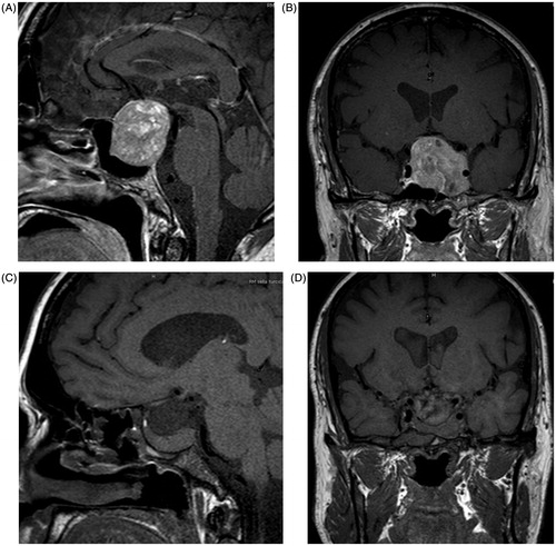 Figure 1. MRI imaging of pituitary stalk. (A) Presurgery sagittal section of T1-weightened sequence. (B) Presurgery coronal section of T1-weightened sequence. (C) Postsurgery sagittal section of T1-weightened sequence. (D) Postsurgery coronal section of T1-weightened sequence.