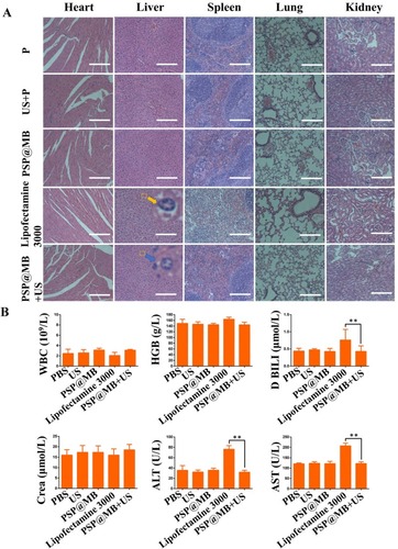 Figure 7 Biosafety evaluation.Notes: (A) Histological examination of hematoxylin and eosin (H&E) staining of vital organ (heart, liver, spleen, lung, kidney) sections. The result of H&E staining assay showed symptoms of swell, fatty and vacuolar in the liver cells treated by lipofectamine 3000 (yellow arrow). The PSP@MB+US group (blue arrow) demonstrated the normal morphology of liver cells compared with plasmid group (scale bar=100 μm). (B) The liver functions (ALT and AST), the renal functions (Crea), Direct Bilirubin (D BILI) and routine blood parameters (hemoglobin and white blood cell) were tested. All the biochemical parameters in serum and routine blood test remained at a normal range in PSP@MB and ultrasound group. Compared with PSP@MB and ultrasound group, the activity of ALT, AST and D BILI were increased significantly in lipofectamine 3000 group. The histopathological and liver functions results exhibited that PSP@MB displayed better biocompatibility than lipofectamine 3000 at a certain concentration in vivo. Data are represented as mean ± standard deviation; n = 3; **P<0.01.