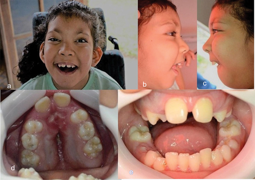 Figure 1. Intra and extraoral images: (a) frontal; (b) right side of the face; (c) left side of the face; (d) maxillary teeth; and (e) mandibular teeth.
