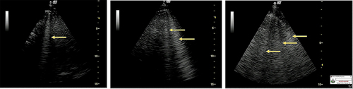 Figure 1 The lung ultrasonography demonstrates the B-lines (arrows).
