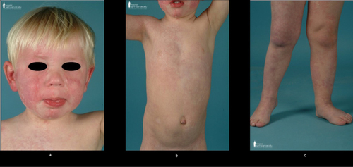 Figure 3 GNA11 SWS phenotype. Facial, truncal and appendicular extensive, reticulated and blotchy capillary malformation (a–c).
