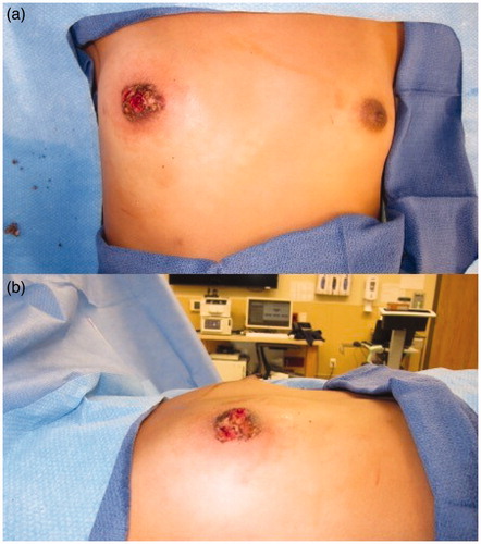 Figure 2. Using loop cautery, the angiofibroma was carefully, tangentially excised to the dermis of the skin. (a) Anterior view. (b) Lateral view.