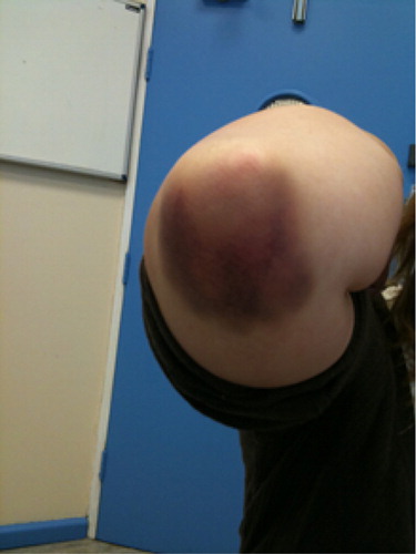Figure 1. Severe elbow bruising following minor trauma in a 22-year-old female patient who has platelets <10 × 109/l.