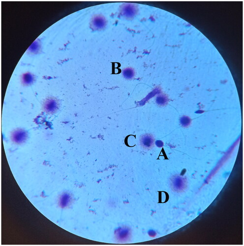 Figure 2. Sperm DNA fragmentation was evaluated with sperm chromatin dispersion test. In this test, spermatozoa without halos and with small halos are considered abnormal with fragmented DNA. Spermatozoa with medium and large halos are considered normal with intact DNA. (A) Spermatozoon without halo, (B) Spermatozoon with small halo, (C) Spermatozoon with medium halo, (D) Spermatozoon with large halo (×1,000).