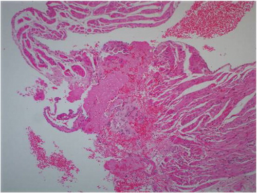 Fig. 2 Mild inflammatory cell infiltration and myonecrosis myocardial tissue in the diabetic control group, HEx200.