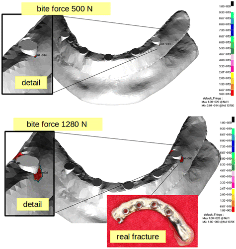 Figure 3 Number of cycles up to damage and damage location on real dental bridge