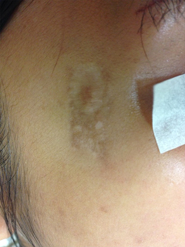 Figure 6 Dyspigmentation and scarring after high-intensity focused ultrasound technology in patient with Fitzpatrick skin type IV.