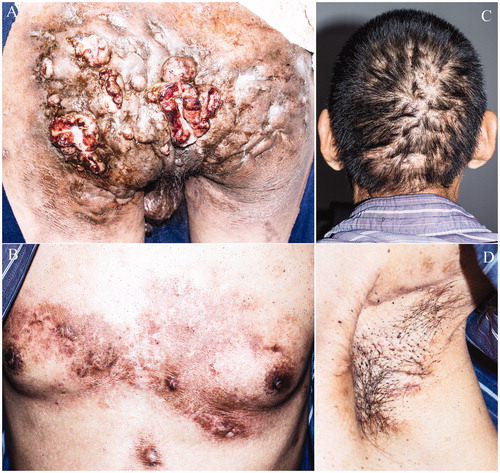 Figure 1. Interconnecting abscesses, sinuses, fistulas, and fibrotic scar tissue were observed affecting both sides of the buttocks (Hurley stage III). The tumor was exophytic with a central crater and bleeding (A). Linear, disfiguring scars and black comedones were seen on the chest (B), the scalp (C) and the axillae (D).