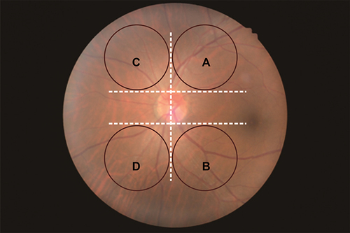 Figure 3 Schematic diagram of the 4 areas selected for analysis of left eye. (A) superior temporal, (B) inferior temporal, (C) superior nasal, (D) under nasal.