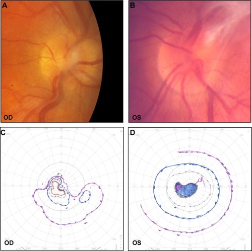 Figure 2 Patient 2.