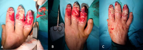 Figure 3. PAT graft application. A: After debridement PAT grafts were adapted to the defect. B: Exposed extensor tendons and distal phalanx components were completely covered with PAT grafts. C: Immediate full-thickness skin grafting after adaptation of PAT grafts.