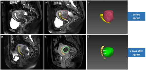 Figure 3. 3D reconstruction of MRI before and after ablation in a case of Extrinsic adenomyosis located at the posterior wall (type II). A 37 year-old woman who presented with HMB, had focal adenomyosis located at the posterior wall (type II) (A). 3D reconstruction of pre-ablation MRI showed that the volume of uterine corpus, adenomyotic lesion and endometrium was 209.74 ml, 38.8ml, and 8.76 ml respectively; the baseline ISA of EMJ was 34.1 cm2 (B,C). Post-ablation MRI showed obvious edema around the ablation zone (D), without any damage to the ipsilateral EMJ (E). 3D map after treatment showed no overlap between ablation zone and EMJ (arrows) (F). The NPVr reached 98.3%, the ablation rate of EMJ was 0. During the follow-up, this patient had PR at 3 months, NR at 6 and 12 months after treatment.