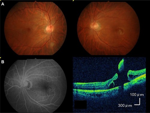 Figure 1 (A) Ophthalmoscopy revealed a horseshoe-like tear on the temporal side of the macula in the left eye. (B) Fluorescein angiography revealed a non-perfusion area and that there was no retinal vein occlusion. (C) Spectral-domain optical coherence tomography revealed the focal retinal detachment in the left eye reached the fovea.