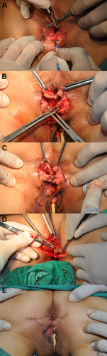 Figure 1 Surgical steps of modified perineal reconstruction combined with anal sphincter repair. (A) Horizontal incision of rectovaginal septum; (B) looking for the broken external anal sphincter; (C) repair of external anal sphincter; (D) making V-Y advancement flap; (E) postoperative appearance.