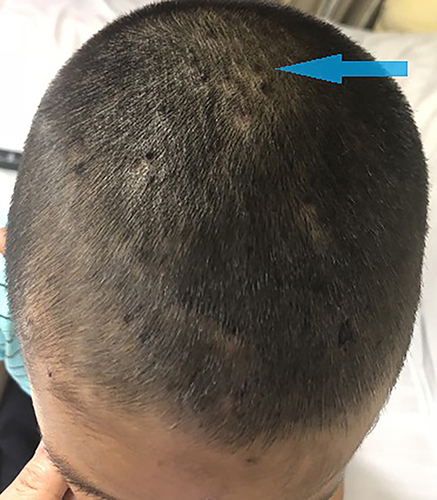 Figure 1 Bee stings on the head and face (The arrow shows scattered needle-like wounds from bee stings on the top of the head).