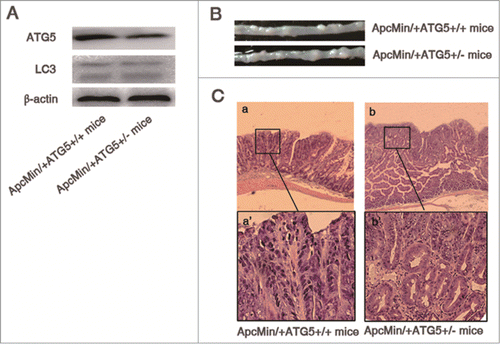 Figure 1. Heterozygous deletion of ATG5 promotes tumor growth in ApcMin/+ mice. (A) ATG5 and LC-3 protein levels in adenomas were determined by Western blotting with β-actin as a loading control. (B) Representative images of intestinal tracts from ApcMin/+ATG5+/+ and ApcMin/+ATG5+/- mice at age 6 months. (C) Micrographs of hematoxylin and eosin stained colonic tumor sections. Histological analysis showed that dysplasia, loss of nuclear polarity and complex crypt outlines with cribriform glands in adenomas of both ApcMin/+ATG5+/+ mice (a and a‘) and ApcMin/+ATG5+/− mice (b and b’). Heterozygous deletion of ATG5 had no significant effect on the malignant progression of Apc-mediated intestinal tumor. Images a‘ and b’ (×200 magnification) are high magnification of insets in a and b (×40 magnification), respectively.