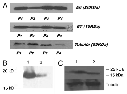 Figure 2 Western blot of cervical tumor cell lysates showing E6 and E7 expression: (A) E6 and E7 in tumor tissues from 4 patients with metastatic cervical cancer. P1–P4, Patients 1–4; (B) E6 in CasKi tumor (line 1) and in patient tumor (line 2); (C) E6 in patient tumor (line 1) and in SiHa tumor (line 2).