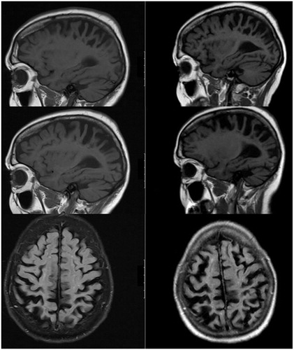 Figure 1 Two MRI scans of the brain were performed with an interval of one year. The figure shows 3T T1weighted images of (A) the left hemisphere, (B) the right hemisphere, and (C) transverse slices. The initial scan shows some generalized atrophy, perhaps more prominently of the parietal lobe, but which was considered to be within the range of normal for her age. The follow-up MRI (at time of second opinion) showed progressive bilateral atrophy of the parietal lobes in particular (Koedam score grade 3) and to some extent in the adjacent frontal and occipital regions. The hippocampus did not appear atrophic (MTA grade 1). There some white matter changes (Fazekas grade 2). There were no mass lesions and there was no enhancement after the administration of gadolinium.