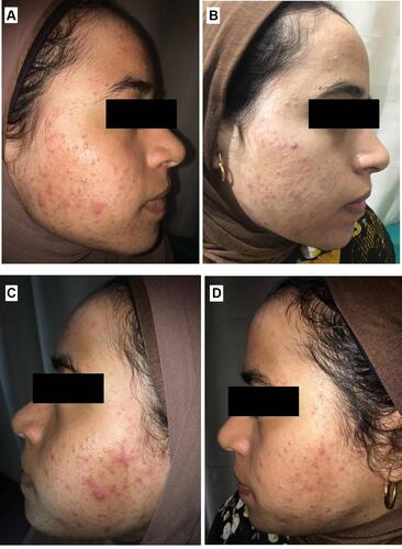 Figure 10 Right side of face before (A) and after topical tretinoin (B). Left side of the face before (C) and after ethosomal RP hydrogel (D). Peeling and dryness noted after topical tretinoin.