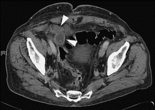 Figure 2.  CT scan at week 14