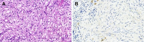 Figure 3 Massive bone marrow infiltration with ECD (original magnification).