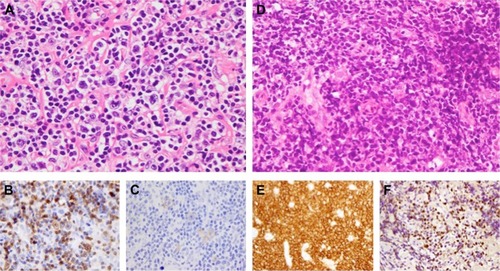Figure 3 Epstein–Barr virus (EBV)-positive diffuse large B-cell lymphoma (DLBCL) developed during forodesine therapy.