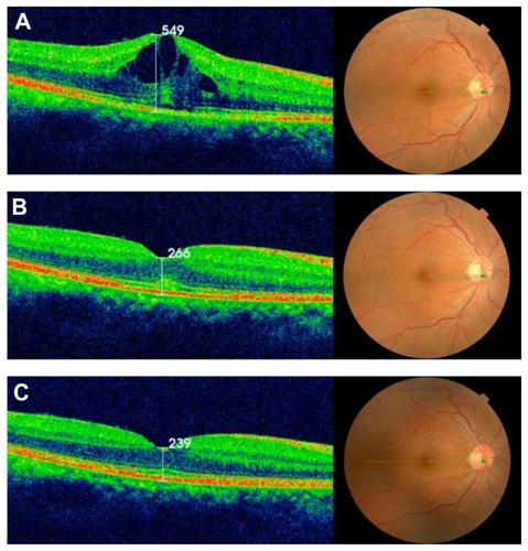 Figure 1 (A) Vertical section of the macular area of the right eye by optical coherence tomography showing cystoid macular edema. (B) Vertical section of the macular area of the right eye 2 days after subtenon triamcinolone injection. A quick recovery was observed. (C) Two years after subtenon triamcinolone injection, no recurrence of cystoid macular edema was observed.