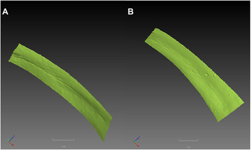 Figure 7 Reconstruction of B4 scar before (A) and after (B) carboxytherapy.