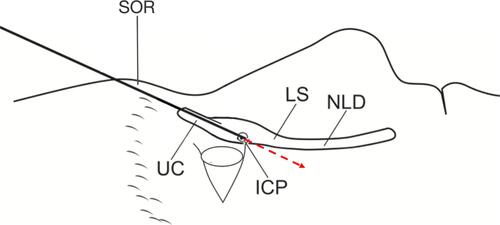 Figure 1 SOR–ICP line as an anatomical limitation. The line formed by the SOR–ICP is the anatomical limit where the tip of a straight probe can reach most anteriorly after entering the LS through the ICP. The red arrow indicates when the LS and NLD inclined anteriorly to the line formed by the SOR–ICP. Manipulating straight probes poses a risk for forming an iatrogenic false passage posterior to the original lacrimal duct.