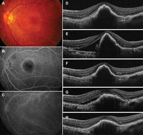 Figure 1 Findings from case 1, a 66-year-old woman with a large pigment epithelial detachment in the left eye.
