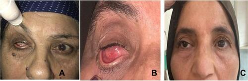 Figure 3 Case 1. (A) Preoperative appearance with contracted socket grade 2. (B) Postoperative socket appearance with adequate fornix depth. (C) Postoperative acceptable prosthesis fitting.