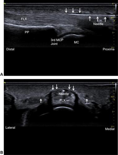 Figure 3 (A) Ultrasound-guided percutaneous A1 pulley release by acupotomy. Long-axis view of the FLX show the A1 pulley at the MCP joint, and the needle-knife advanced into the A1 pulley horizontally under ultrasound-guided. The thin hypoechoic A1 pulley is identified by ↓, the hyperechoic needle-knife identified by ↑; (B) short-axis view of the FLX show the A1 pulley, the thin hypoechoic A1 pulley is identified by ↓, the hypoechoic neurovascular identified by ↑, the hyperechoic needle-knife is in the midline and avoids the neurovascular.