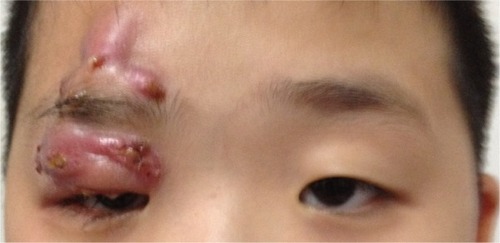 Figure 2 Right upper eyelid still swollen and inflamed with partial mechanical ptosis at 1 week post-incision and drainage procedure.