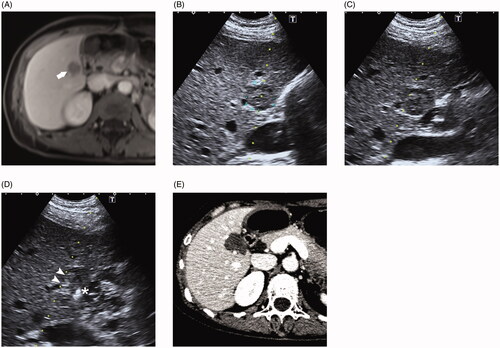 Figure 2. (A) 47-year-old female who had a history of hepatic resection for hepatocellular carcinoma shows a recurrence lesion in segment 6 demonstrated by MRI. The hepatic mass is close proximity to the duodenum. (B) Ultrasound reveals the lesion is in direct contact with adjacent duodenum. (C) After introducing artificial ascites, the duodenum is not completely separated from the contacting liver. (D) Radiofrequency ablation (RFA) combined with ethanol injection was performed to ablate this tumor. A PTC needle (asterisk) was inserted into the tumor margin proximal to the duodenum and the RFA electrode (arrowheads) was positioned 10 mm away from the PTC needle. (E) One-month post-ablation CT showed a complete ablation without duodenum injury.