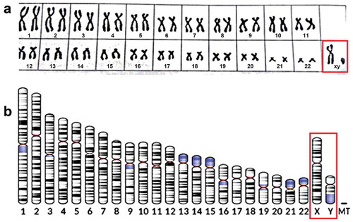 Figure 1. a. General human karyotype. Author: Raj.paljun13 Own work (Created 11/03/2016). Background color has been made less dark than in original. Copyright permission: freely accessible under creative Commons (CC BY-SA 4.0). With thanks to the author. From Wikipedia: Karyotype (human male). [Citation9] b. Ideogram of human chromosome. Chromosome Y highlighted. G-band, 850 bphs (bands per haploid set). Black and gray: Giemsa positive. Red: Centromere. Light blue: Variable region. Dark blue: Stalk National Center for Biotechnology Information, U.S. National Library of Medicine – File created 29 July 2017 NCBI’s Genome Decoration Page. From Wikipedia: Testis Determining Factor. [Citation10] Copyright: Public domain, with thanks. X: X chromosome; Y: Y chromosome; MT: mitochondrial.