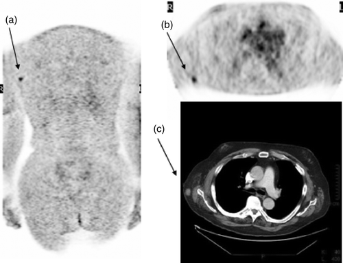 Figure 1.  60-year-old male operated previously due to stage IIB melanoma in the back. FDG PET coronal slice (a, arrow) and transaxial slice (b, arrow) revealed an FDG-avid lesion near the right axilla (scanned arms down) corresponding a small (10 mm) tumour in diagnostic CT, arms up (c, arrow). Histological study confirmed a melanoma metastase.