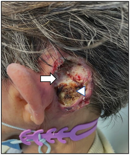 Figure 3. A fungating mass with crusting in the mastoid region (arrowhead) and exposed mastoid cavity with keratin debris(arrow) before radiotherapy was commenced.
